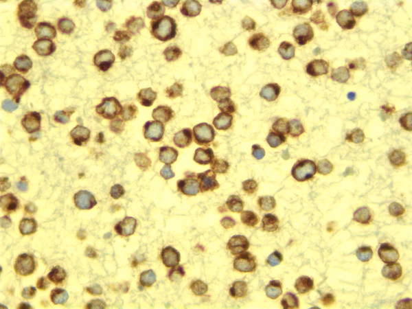Cell block stained with CK20 demonstrating sharp perinuclear dot like pattern.
