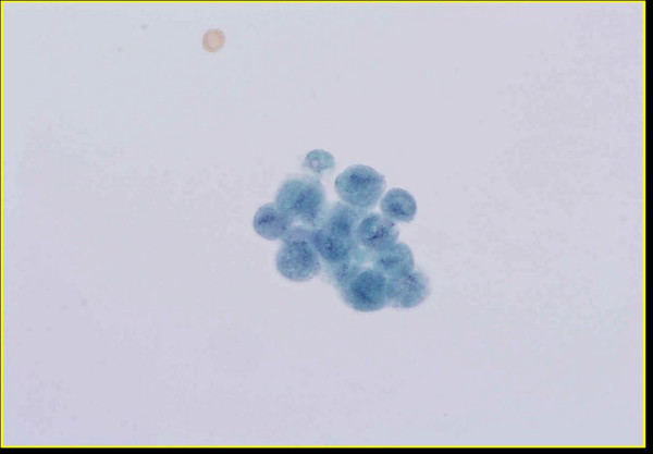 Group of Trichomonas organisms present in urine (Thin- Prep™, Papanicolaou stain).