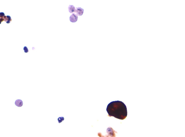 Cytokeratin immunocytochemistry. A single urothelial cell demonstrates strong cytokeratin immunoreactivity whereas surrounding trichomonads are negative. Degenerated inflammatory cells are also present in this field.