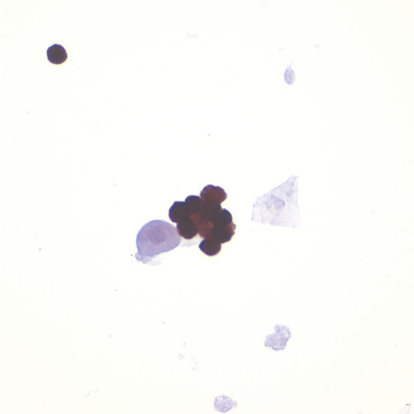 p16 immunocytochemistry. A group of trichomonads demonstrate strong p16 immunoreactivity whereas an adjacent degenerated urothelial cell and squamous cell are negative.