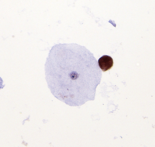 A single trichomonad, adjacent to an unstained exfoliated squamous epithelial cell, is shown to be p16 immunoreactive.