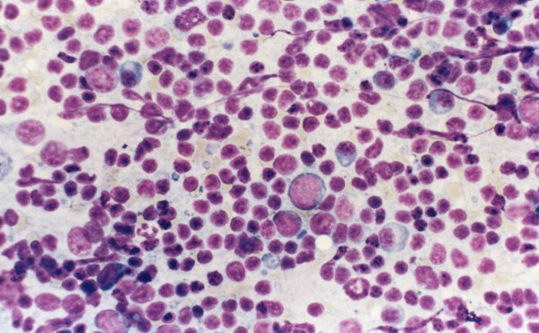 A case of reactive lymphadenopathy, cytology preparation shows a mixture of small and large lymphocytes, plasma cells and macrophages.