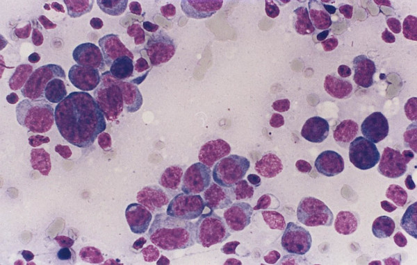 A case of diffuse large B cell lymphoma with limited amount of recovered cells and no diagnostic flow cytometry findings. The cytology preparation shows predominantly large cells with high nuclear/cytoplasmic ratio, irregular nuclei and occasional prominent nucleoli.