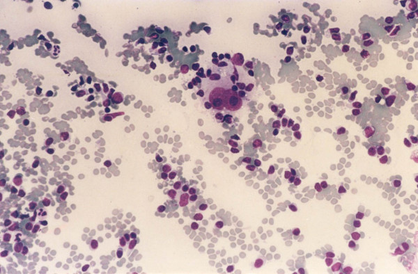A case of classical Hodgkin lymphoma, nodular sclerosis, cytology preparation shows binucleated Reed-Sternberg cells in a mixed cellular background.