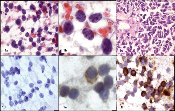 a y b: Papamicolaou; c: biopsy; d: CD45; e: neuron specific enolase; f: vimentin.
