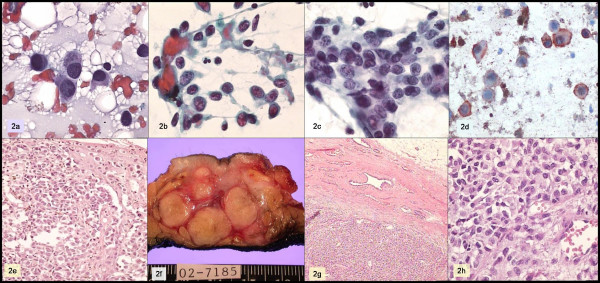 a, b, c: Papanicolaou; d: HMB-45; e: skin biopsy; f, g, h: breast tumor.