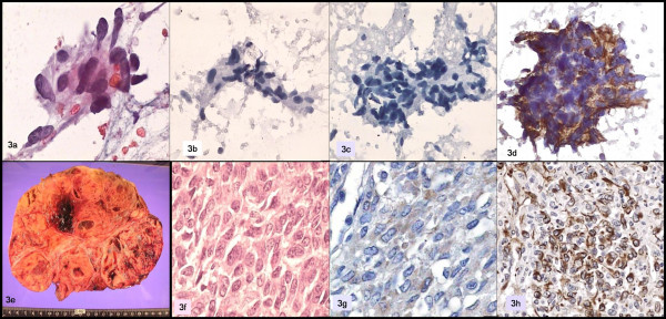 a: Papanicolaou; b: cytokeratin; c: CA 15-3; d: vimentin; e, f: ovarian tumor; g: inhibin; h: WT1.