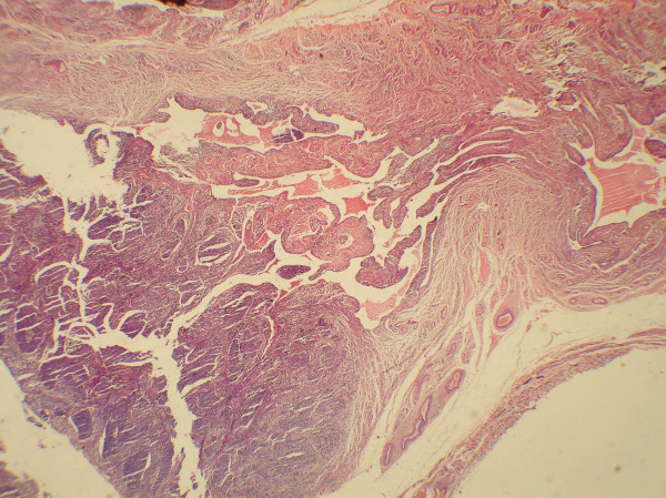 Microphotograph showing a tumor in the lumen of fallopian tube (H&E, 55).