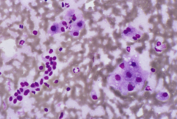 Normal and reactive hepatocytes: FNAB. Monolayered clusters of loosely-cohesive, well-defined, polygonal cells with ample dense, granular cytoplasm, round central nuclei and low nuclear-cytoplasmic ratio. Note the double-layered row of ductular epithelial cells with scanty cytoplasm (May- Grunwald-Giemsa).