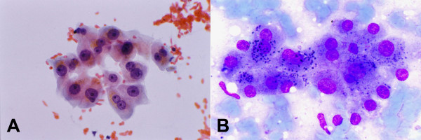 Normal and reactive hepatocytes: FNAB. (A) Hepatocytes show dense granular cytoplasm, round central nuclei, well-delineated nuclear membrane, distinct nucleoli, granular chromatin and binucleation. Note polymorphism displayed by nonneoplastic hepatocytes. The cells contain brown granules of lipofuscin pigment in the cytoplasm (Papanicolaou). (B) Lipofuscin appears as black granules. The two elongated nuclei are likely to be Kupffer cells (May-Grunwald-Giemsa).