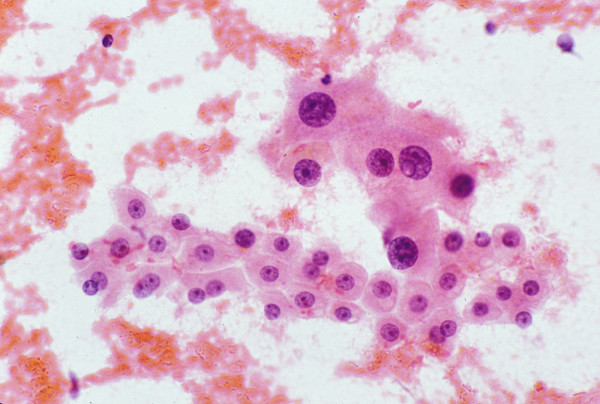 Hepatocytes with large cell change: FNAB. There is simultaneous nuclear and cell enlargement of the hepatocytes, thus maintaining the nuclear-cytoplasmic ratio of 1/3. Note mild nuclear atypia (Papanicolaou).