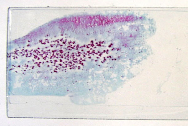 Naked eye inspection of hepatic aspirate. Uniformly granular pattern of spread of classic hepatocellular carcinoma. Note the regularly irregular tumor fragments which tend to be equidistant (Papanicolaou).