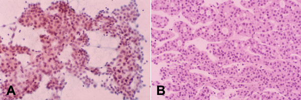 Well-differentiated hepatocellular carcinoma with trabecular and pseudoacinar patterns: FNAB. (A) Thick arborizing cords of malignant hepatocytes showing cellular monotony, increased nuclear-cytoplasmic ratio, and impression of nuclear crowding. The circular spaces among the cords represent pseudoacini (Papanicolaou). (B) Corresponding histologic section of the tumor shows trabecular-sinusoidal arrangement with pseudoacini. Note the uniformity of the tumor cells and cords 2 to 3 cells thick (H&E).