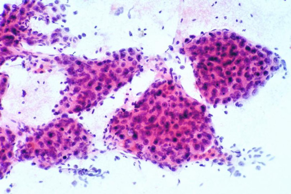 Moderately differentiated hepatocellular carcinoma: FNAB. Thick cords of malignant hepatocytes are wrapped by peripheral endothelium. They appear to be floating on transverse section view (Papanicolaou).