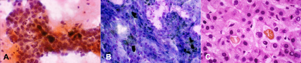 Moderately differentiated hepatocellular carcinoma with pseudoacinar pattern: FNAB. (A) Pseudoacini filled with bile which appears as dark brown blobs (Papanicolaou) (B) Bile appears black (May-Grunwald-Giemsa). (C) Corresponding histologic section of the tumor shows cystically dilated canaliculi filled with golden-brown bile and surrounded by polygonal cells with central nuclei (H&E).