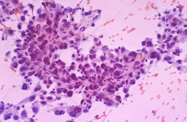 Poorly differentiated hepatocellular carcinoma: FNAB. High-grade tumor shows marked pleomorphism but still retaining some hepatocytic characteristics (Papanicolaou).