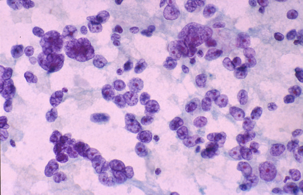 Poorly differentiated hepatocellular carcinoma: FNAB. Atypical naked hepatocytic nuclei exhibit pleomorphism, thin nuclear membrane, nuclear contour irregularities, prominent nucleoli and multinucleation (Papanicolaou).