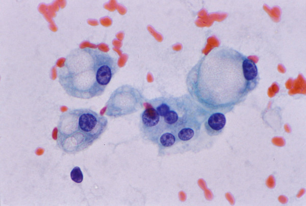 Fatty change: FNAB. Hepatocytes exhibit polymorphism and contain cytoplasmic fat vacuoles of varying sizes pushing nucleus to one side. Cytologic picture can mimic signet-ring cell adenocarcinoma (Papanicolaou).