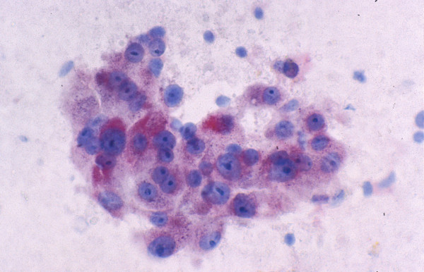 Hepatocellular carcinoma: FNAB. The tumor cells stain positively for alpha-fetoprotein (Immunostain).