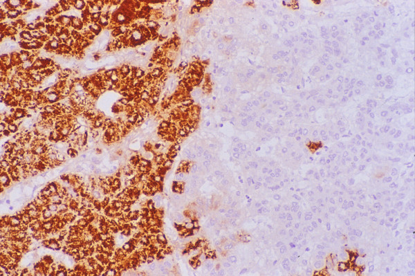 Hepatocellular carcinoma: Histology. Parts of the tumor show intense granular cytoplasmic reactivity with HepPar1 (Immunostain).