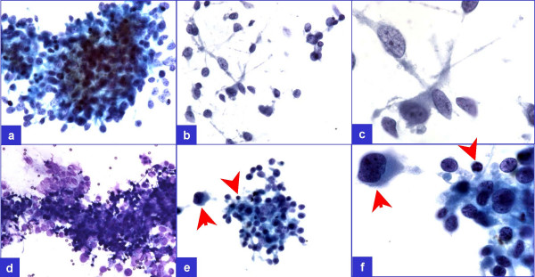 A few groups (a through d) did not show pleomorphism but showed occasional lymphocyte (arrowheads in e & f) admixed with the tumor cells demonstrating ill-defined cell borders superficially resembling a granuloma. However, pleomorphic cells (arrows in e & f) were not uncommon in this relatively cellular specimen.