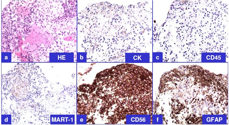 Representative immunoprofile of tumor cells on cellblock sections (see also table 1) a. H&E; b. Cytokeratin (non-immunoreactive); c. LCA (non-immunoreactive); d. MART-1 (non-immunoreactive); e. CD56 (immunoreactive); f. GFAP (immunoreactive).