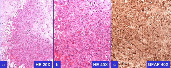 Histomorphology and GFAP immunoreactivity of previously resected GBM.