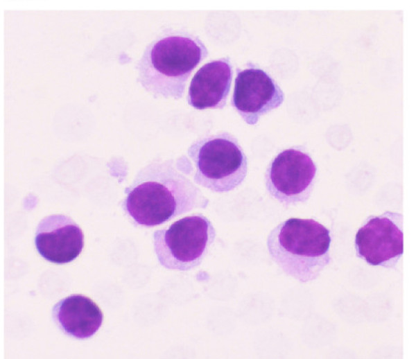 Aspirate from the EUS-FNA of lymph node revealed small to intermediate sized mononuclear cells with moderate cytoplasm, round to oval nuclei with smooth nuclear borders, a stippled chromatin pattern and occasional single nucleoli. The cytoplasm is pale grey with hair-like and short, blunt, cytoplasmic projections. (Stain: Diff Quik, Magnification: × 40).