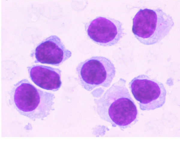 A higher magnification of the aspirate from same area as shown in Figure 1 shows small to intermediate sized mononuclear cells with moderate cytoplasm, round to oval nuclei with smooth nuclear borders, a stippled chromatin pattern and occasional single nucleoli. The cytoplasm is pale grey and granular with hair-like and short, blunt, cytoplasmic projections. (Stain: Diff Quik, Magnification: × 60).