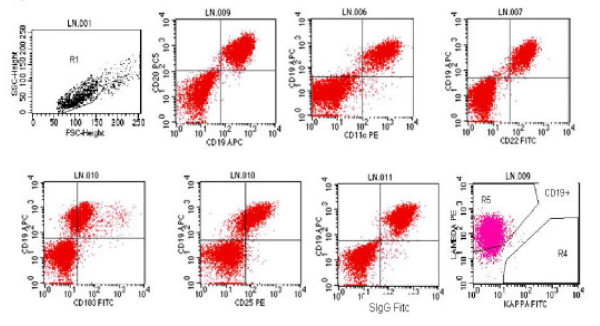 Immunophenotyping performed using selective gating on lymphoid cell population shows that neoplastic cells are positive for clonal B-cells (>98%) expressing CD19, CD20, CD11c bright, CD25 bright, CD103. surface immunoglobulin and are lambda light chain restricted.