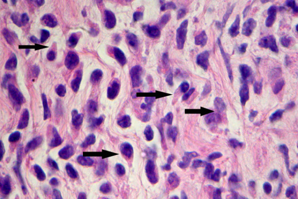 Histologic features from FNA micro-biopsy sample showing frequent cells with Hand-Mirror morphology. Other areas in this tissue and in effusion sample showed increased proportion of eosinophils and plasma cells (H&E stain, 40 × magnification).