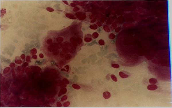 Giant cell tumour showing mononuclear single cells and large multinucleated osteoclast type giant cells attached to the periphery of clusters of spindle cells.