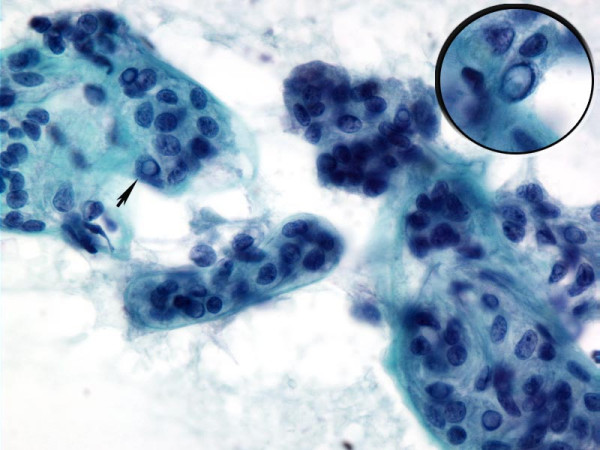 Cytology of HTN. Papanicolaou stained fine-needle aspiration of hyalinizing trabecular neoplasm showing elongated tumor enveloped by or associated with acellular stroma. The tumor cells demonstrate nuclear features of papillary carcinoma (arrow and inset)