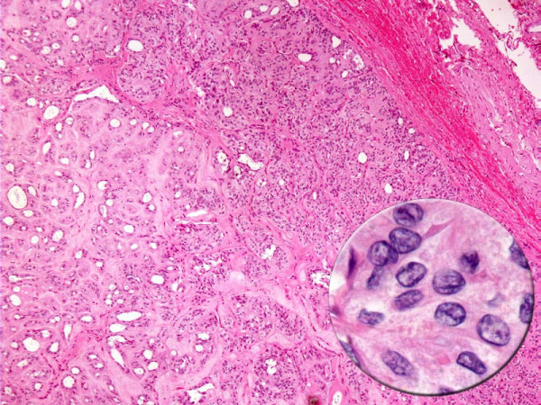 Cytology of HTN. Hyalinizing trabecular neoplasm displaying circumscription, encapsulation, tumor cells arranged in nests with intervening hyalinized stroma. The tumor cells demonstrate nuclear features of papillary carcinoma (inset).