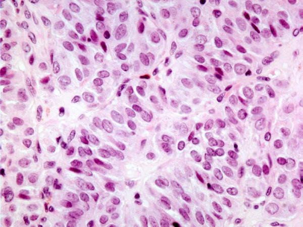 Histology of HTN. Trabecular variant of papillary thyroid carcinoma showing trabecular/paraganglioma-like growth pattern