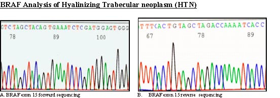 BRAF analysis. Sequence chromatogram of hyalinizing trabecular neoplasm with BRAF exon 15 forward primer shows a wild type sequence
