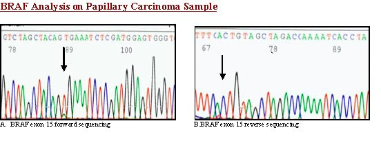 BRAF analysis. Sequence chromatogram of trabecular variant of papillary thyroid carcinoma- with BRAF exon 15 forward primer shows BRAF mutation