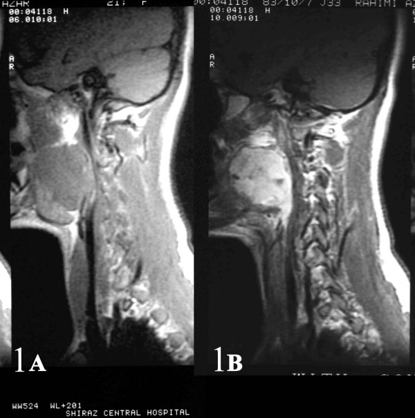 AB: Sagital and coronal (2AB) contrast-enhanced MR images of the right parapharyngeal synovial sarcoma