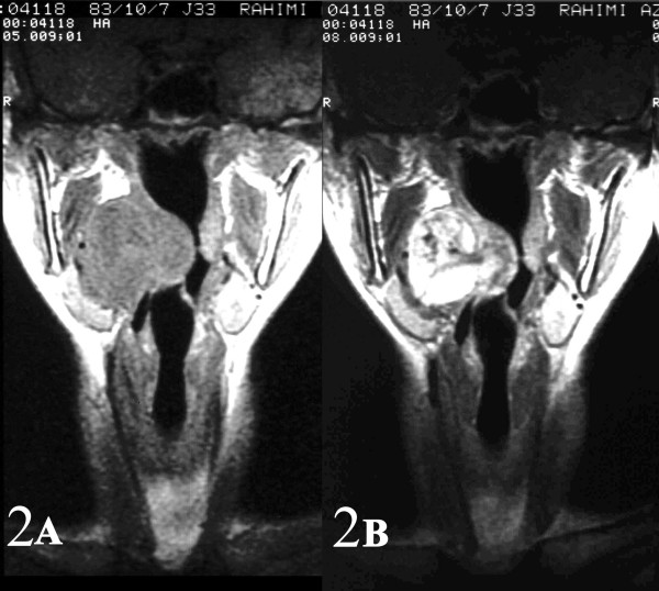 AB: Sagital and coronal (2AB) contrast-enhanced MR images of the right parapharyngeal synovial sarcoma.