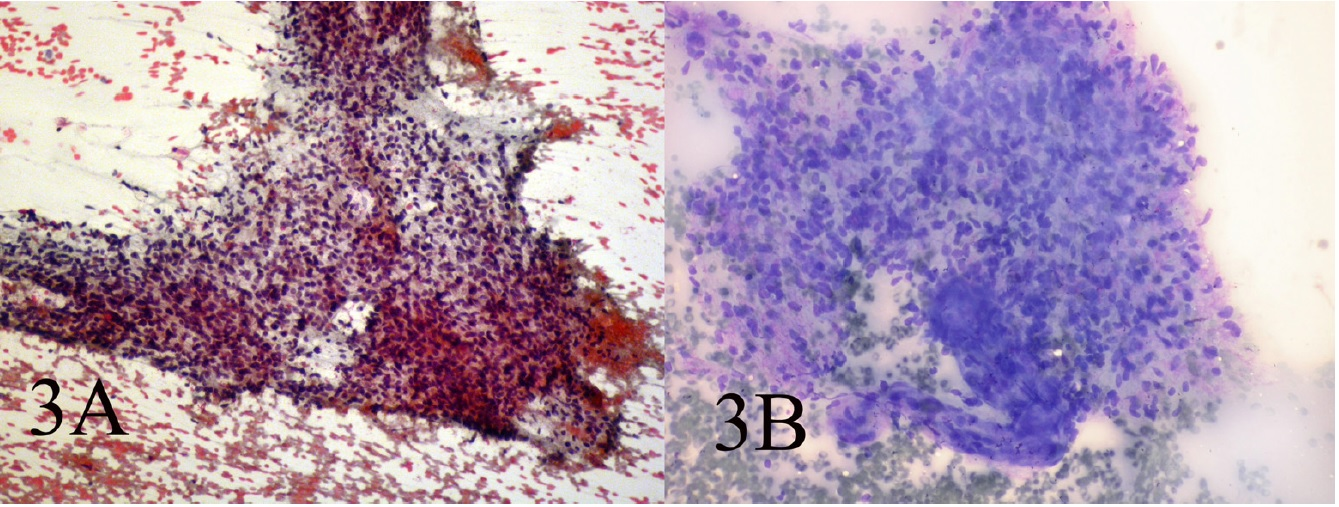 AB: Small and large clusters of cells with bland chromatin, inconspicuous nucleoli, oval to spindle-shaped cytoplasm and branching tumor tissue fragments and vessel stalks(Papanicolaou 100, Wright 100)