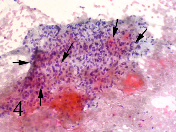 Acinar structures scattered in between spindle cells with scant mucin Background (Papanicolaou, 100).