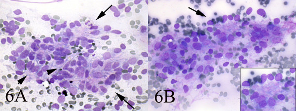 AB: Smears also showed a mixture of dispersed spindle cells(arrow-head) and epitheloid cells which occasionally formed acinar structures(long arrow) (Wright, Wright 400, 400).