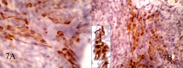 AB: Immunocytochemical staining for CK show focal positivity in spindle cells and also positive EMA in epitheloid cells(inset). (400, 400, inset:600)