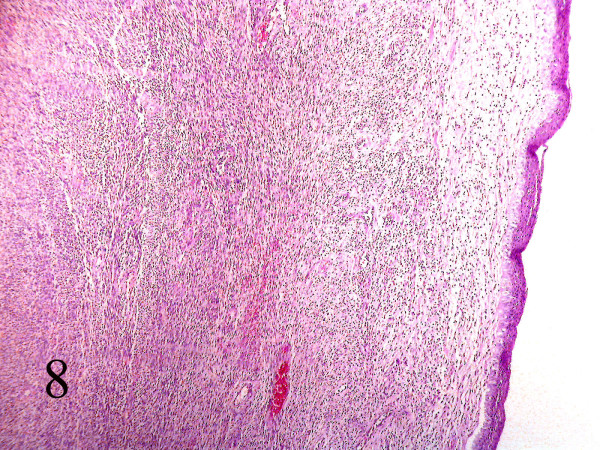 Section of parapharynx showed a submucosal hypercellular tumoral tissue. (Hematoxilin & eosin, 100).