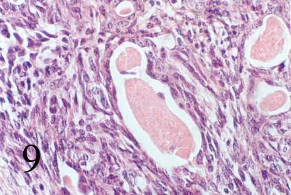 Biphasic pattern of glands and spindle cells (Hematoxilin & eosin, 400).