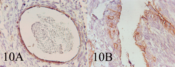 AB: Immunohistochemistry showing EMA and Cytokeratin positivity of the cells lining the glandular and cystic spaces. (400, 400)