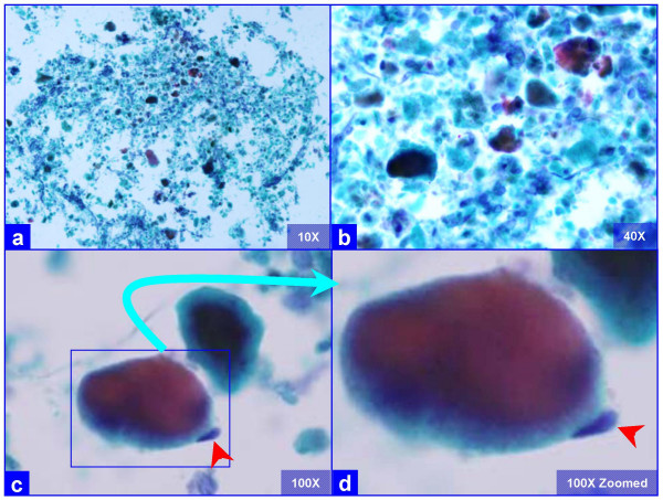 Characteristic globular alveolar casts of amorphous cyanophilic to acidophilic debris (a) are admixed with relatively scant cells (b). Some hyaline globules demonstrate two tone staining (c). The globules of variable sizes range in shapes and dimensions corresponding with alveolar spaces. Occasional pneumocytes may be seen "hugging" the periphery of globules (arrow in d). This is different from the frothy appearance of casts associated with P. carinii pneumonia which show individual vacuoles with central to eccentric dots. (Bronchoalveolar lavage; Papanicolaou stained SurePath Prep™).