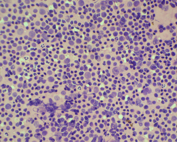 Cytology smear of a case of follicular lymphoma showing mixed small and large cells. (Haematoxylene and Eosin stain).