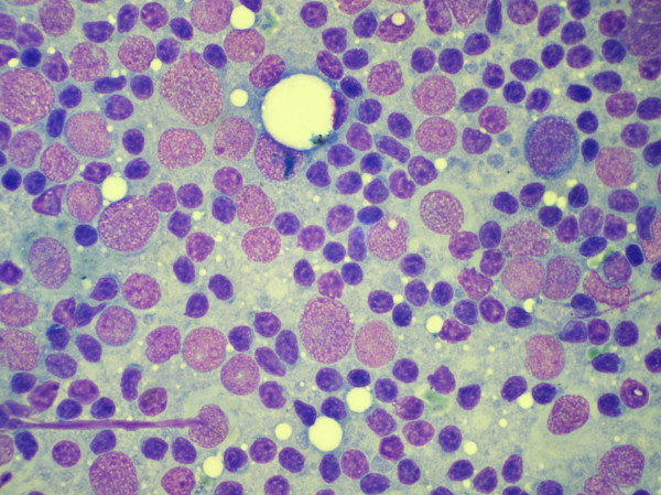 Cytology smear of a case of anaplastic large cell lymphoma showing dissociated cells with moderately pleomorphic large nuclei. (Haematoxylene and Eosin stain).