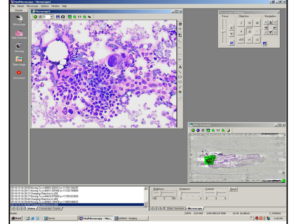 Diagnosis. Figure 3 shows an even higher magnification of the pre-screened region. Large atypical cells with marked pleomorphism, abundant cytoplasm with vacuolization, discohesiveness, and disruption of epithelial architecture are all features seen here that illustrate the telepathology diagnosis of carcinoma